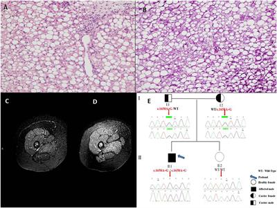 Hepatic Presentation of Late-Onset Multiple Acyl-CoA Dehydrogenase Deficiency (MADD): Case Report and Systematic Review